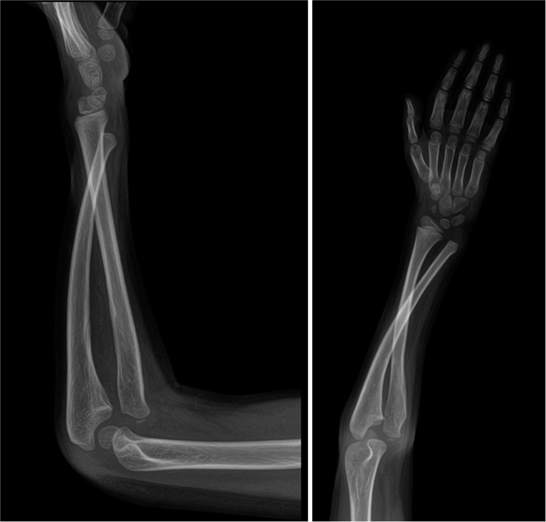 The radiographs show anterior dislocation of the radial head and volar dislocation of the distal ulna with a crossing of both forearm bones.