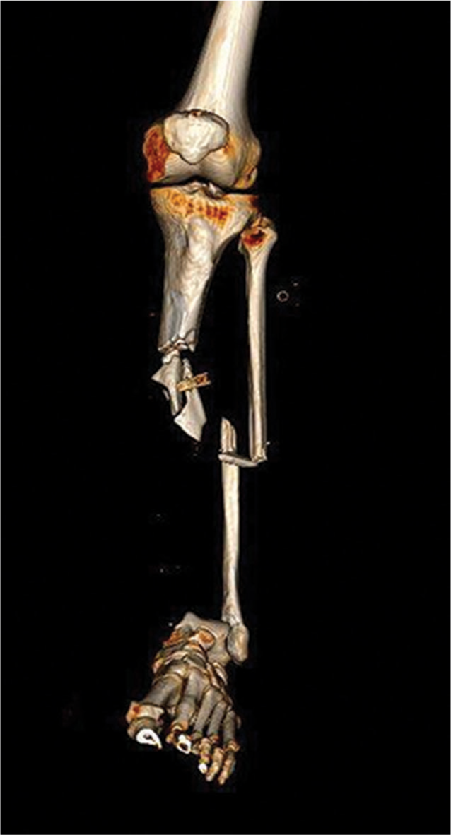 A three-dimensional reconstruction of left lower limb – Computerized tomography.