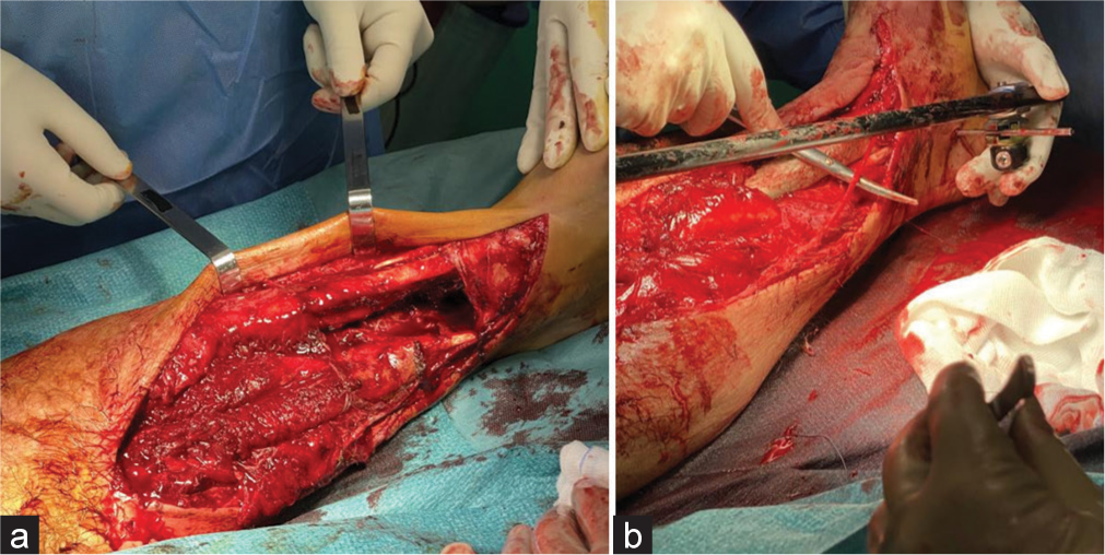 (a) Pictures exhibiting the open injury site and (b) the right great saphenous vein is indicated and intact.