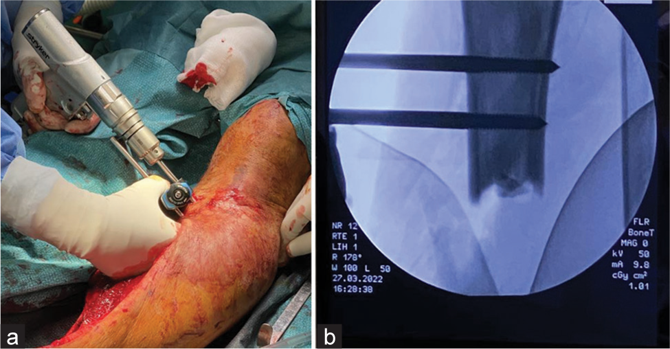 (a) External fixator assembly and (b) intraoperative imaging.