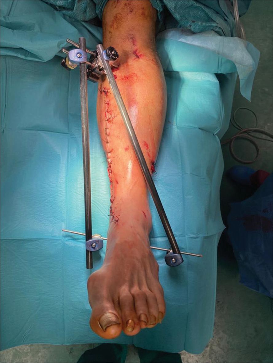 Final post-operative result illustrating wound closure and external fixator.