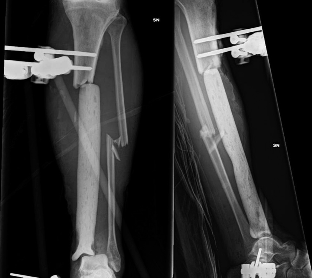 Anteroposterior and lateral post-operative radiographs.