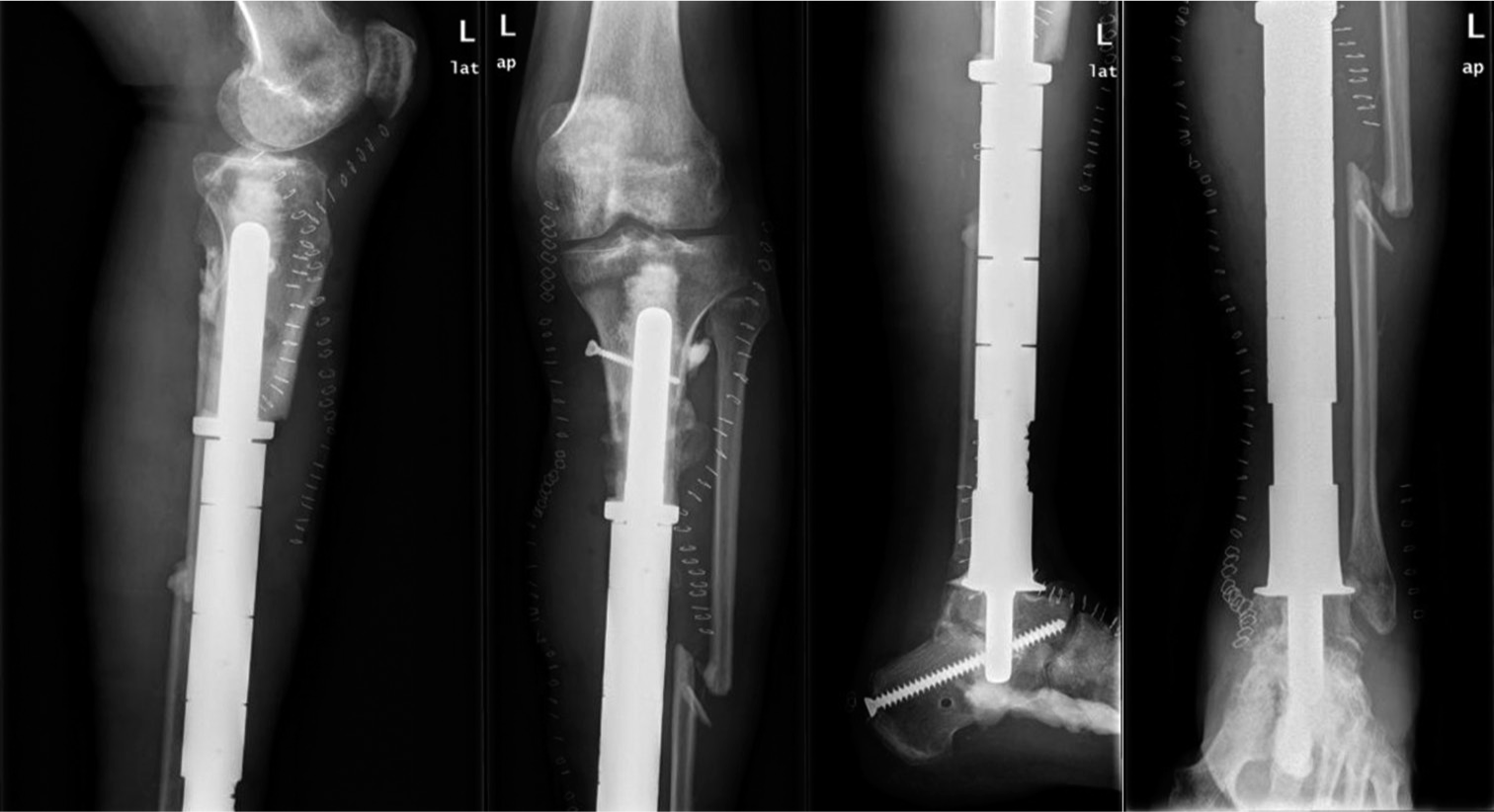 Radiographs illustrating post-operative results following custom-made nail implant for arthrodesis of the tibiotalar joint. Anteroposterior and lateral radiographs of the proximal and distal leg are illustrated.