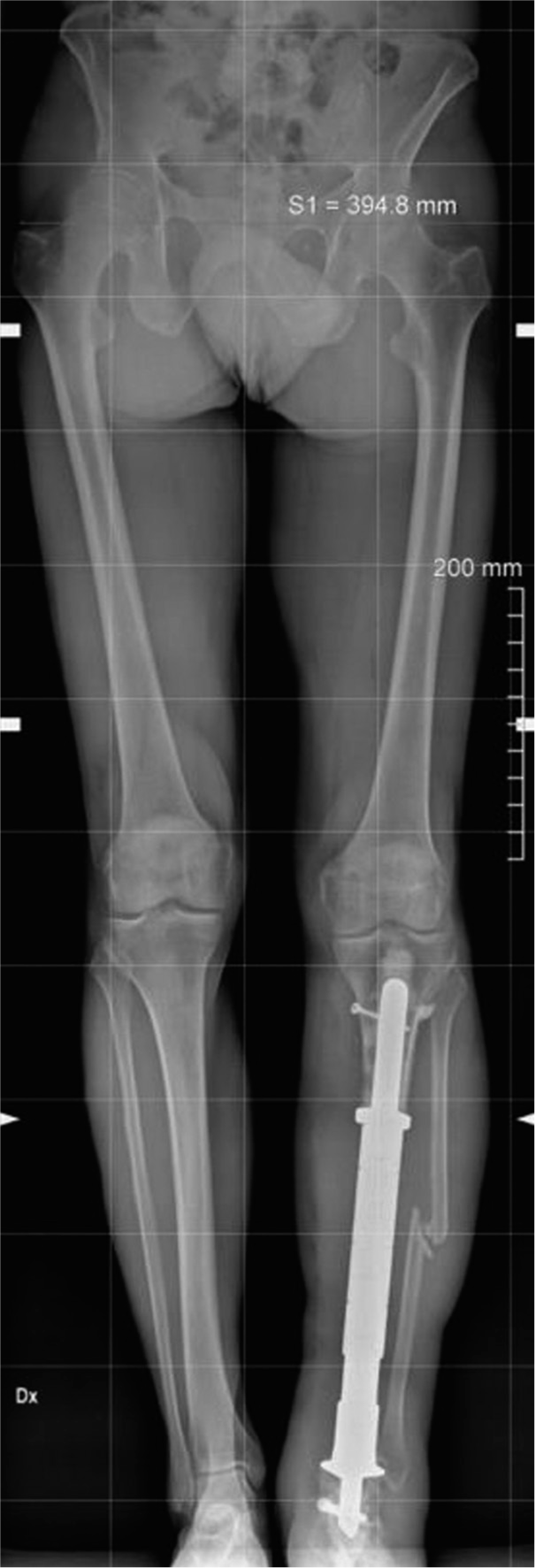 Post-operative weight-bearing scanogram of the lower limbs.