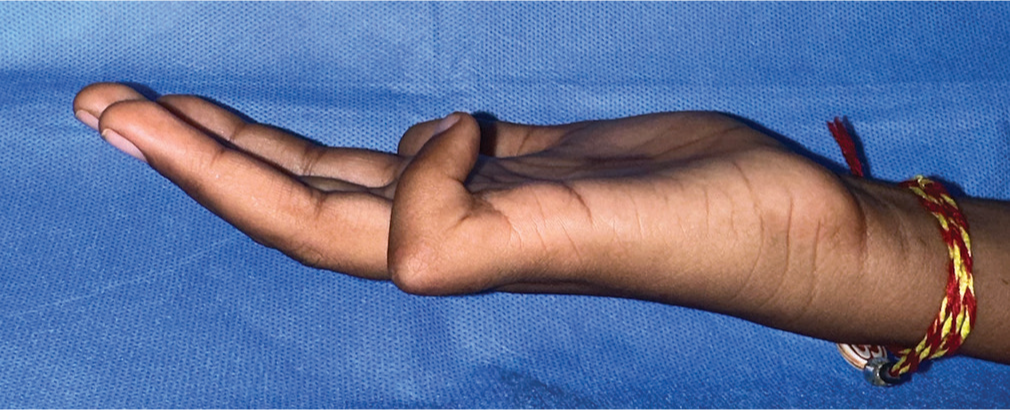 Clinical picture showing a fixed flexion contracture of the little finger.