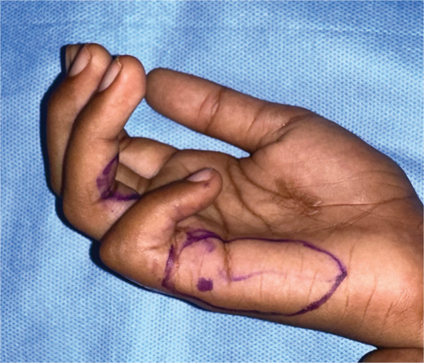 Doppler markings of the perforator guiding us to the distal perforator from the ulnar digital artery.