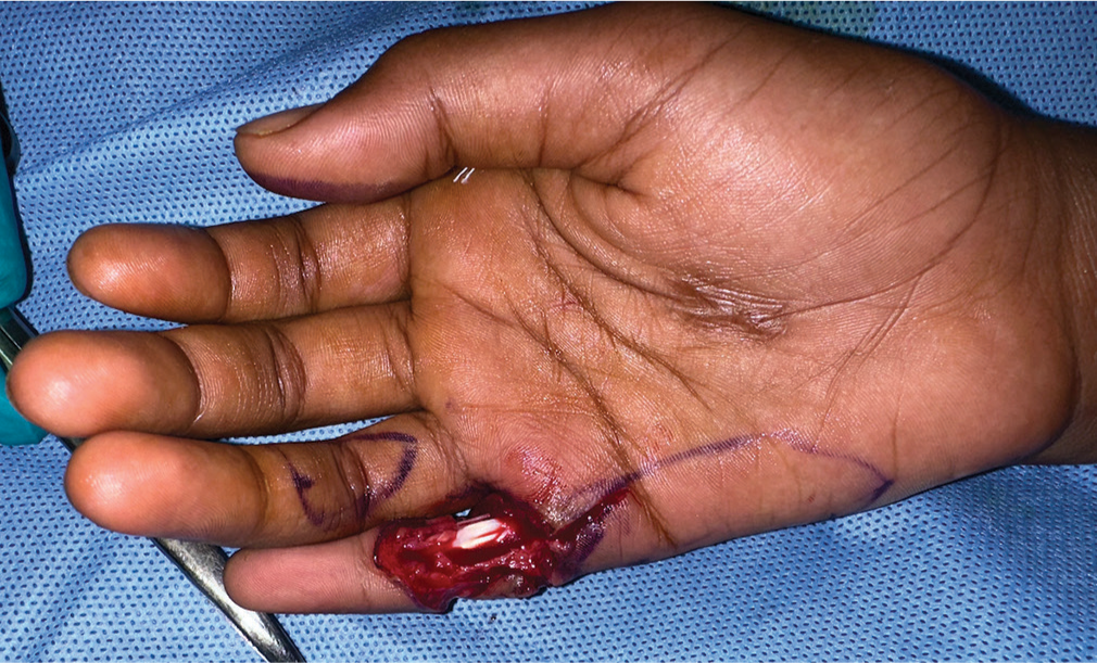 The defect following contracture release, requiring the ulnar digital artery perforator flap.