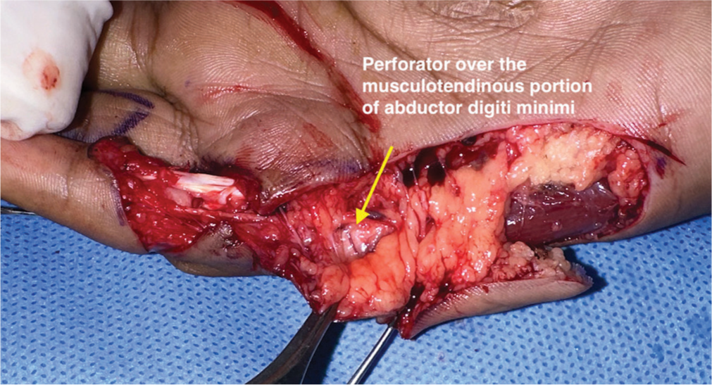 Intraoperative picture showing a reliable distal perforator over the musculotendinous junction of the abductor digiti minimi.