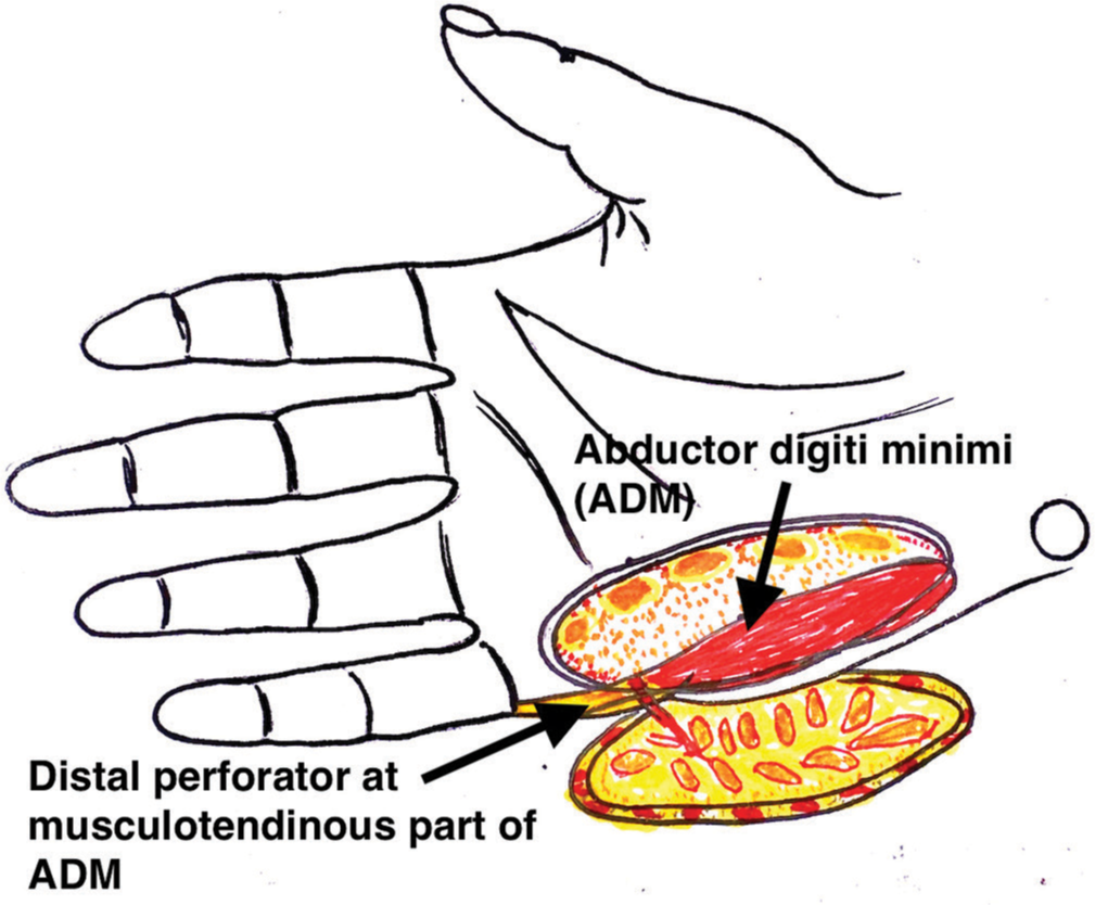 Illustrative diagram of the flap showing the distal perforator located over the musculotendinous portion of the abductor digiti minimi.