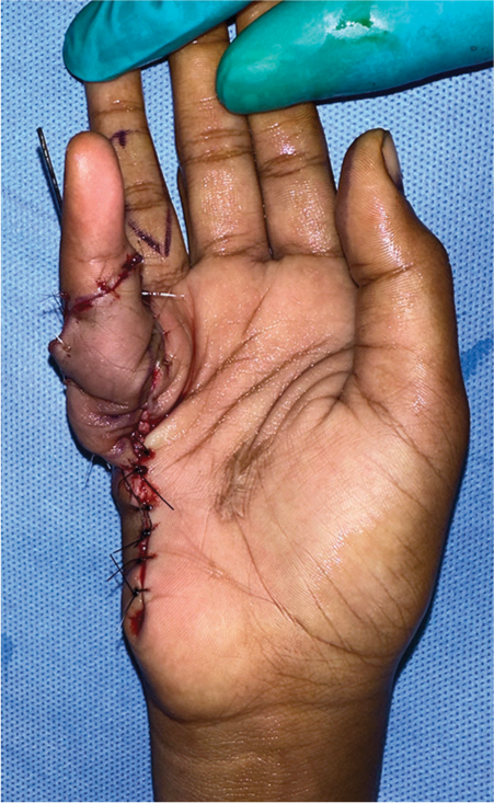 Immediate postoperative picture of the flap and little finger stabilized with a Kirschner wire to maintain deformity correction.