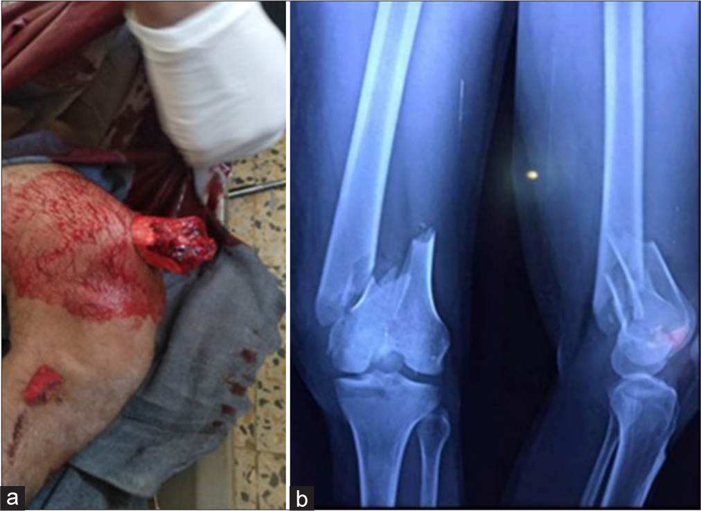 (a) A 26-year-old patient with open distal femur fracture with bone exposed. (b) A radiograph of a patient shows a supracondylar femur with intra-articular extension.