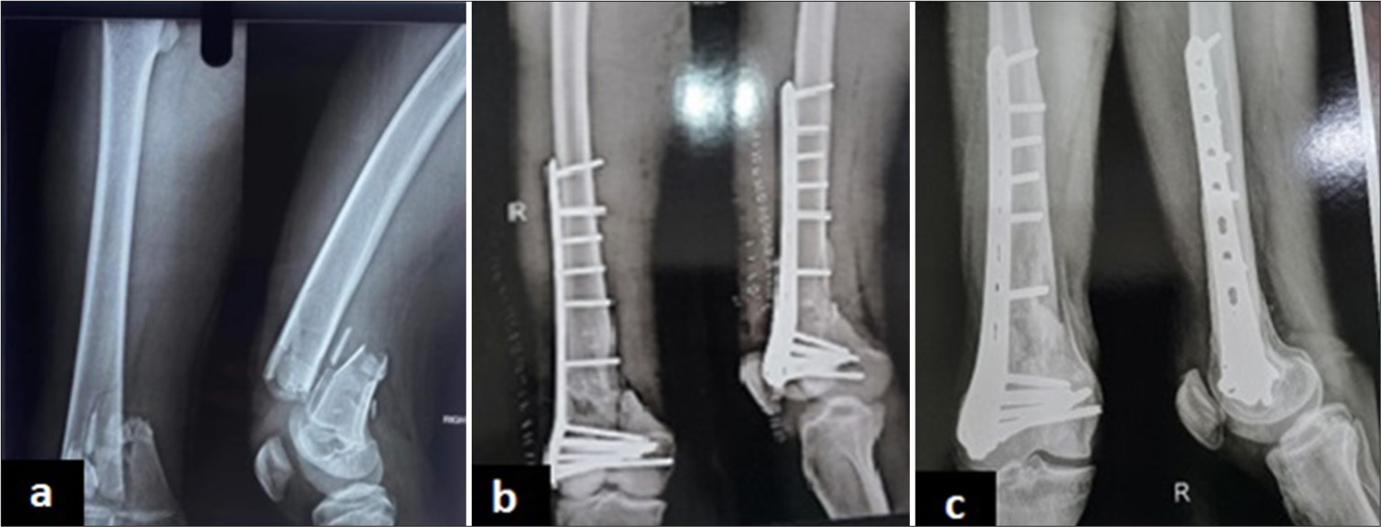 (a) Fracture fixation with distal femur locking plate pre-operative radiograph. (b) Fracture fixation with distal femur locking plate postoperative radiograph. (c) Fracture fixation with distal femur locking plate six months post-operative.