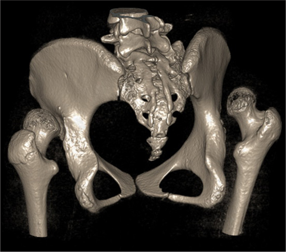 A 15-year-old girl with a bilateral high dislocated hip. Computed tomography scan reconstruction shows a lack of pelvic support without stable pseudo-acetabulum formation.