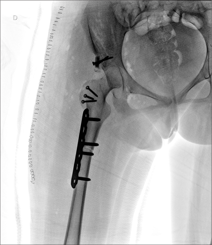 Right hip anteroposterior view radiograph after a Colonna capsular arthroplasty was performed through a controlled surgical hip dislocation, associated with a femoral shortening osteotomy and lateral acetabular bone augmentation.