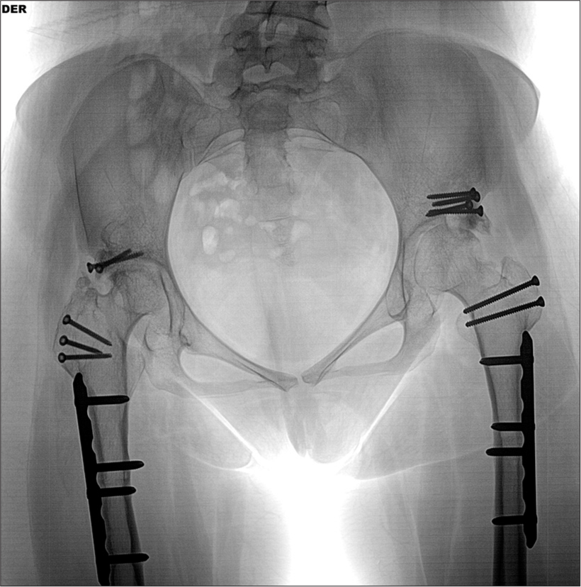 A pelvis anteroposterior view radiograph after the left hip Colonna capsular arthroplasty was performed, 10 months after the first procedure on the right side.