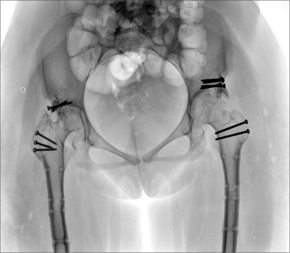 A pelvis anteroposterior view radiograph after hardware removal of femur osteosynthesis, 2 years after the first surgery.
