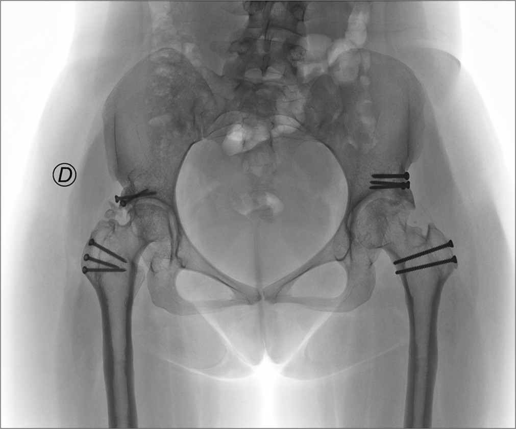 A pelvis anteroposterior view radiograph demonstrates preserved joint space and consolidated osteotomies, 6 years after the first surgery.