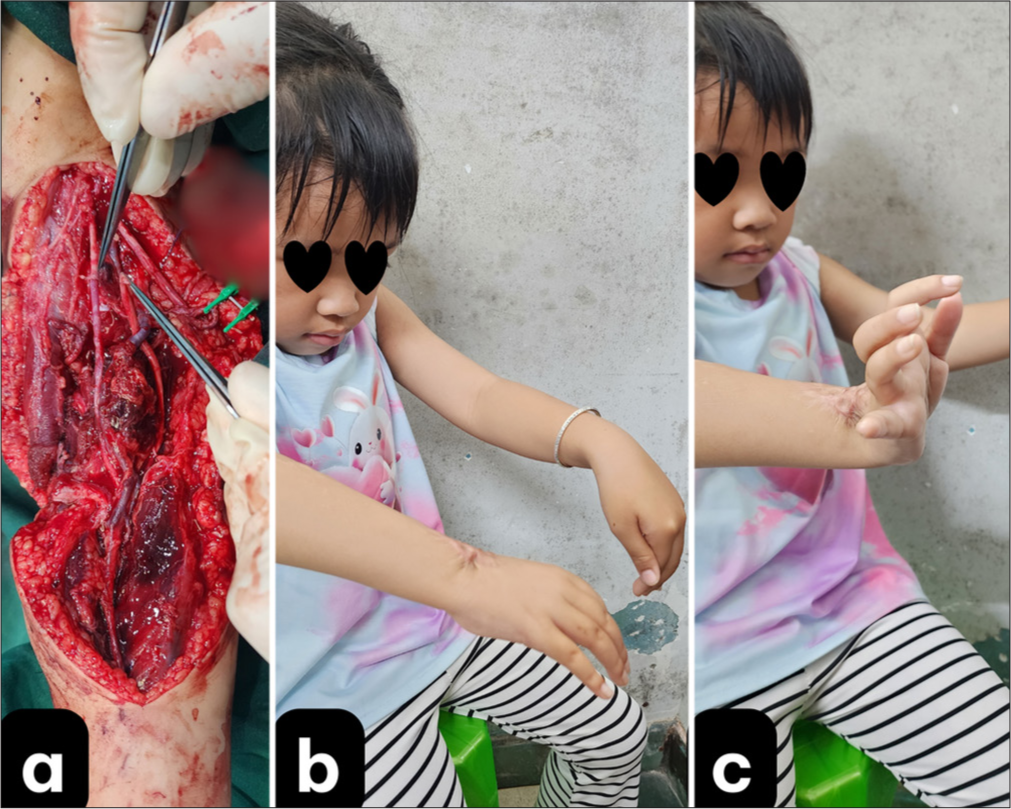 Preparation for microsurgical nerve anastomosis in the arm and post-operative recovery images. (a) Nerve anastomosis preparation after completing vascular anastomosis; (b) right wrist in neutral position; and (c) full extension of the right wrist showing signs of radial nerve recovery.