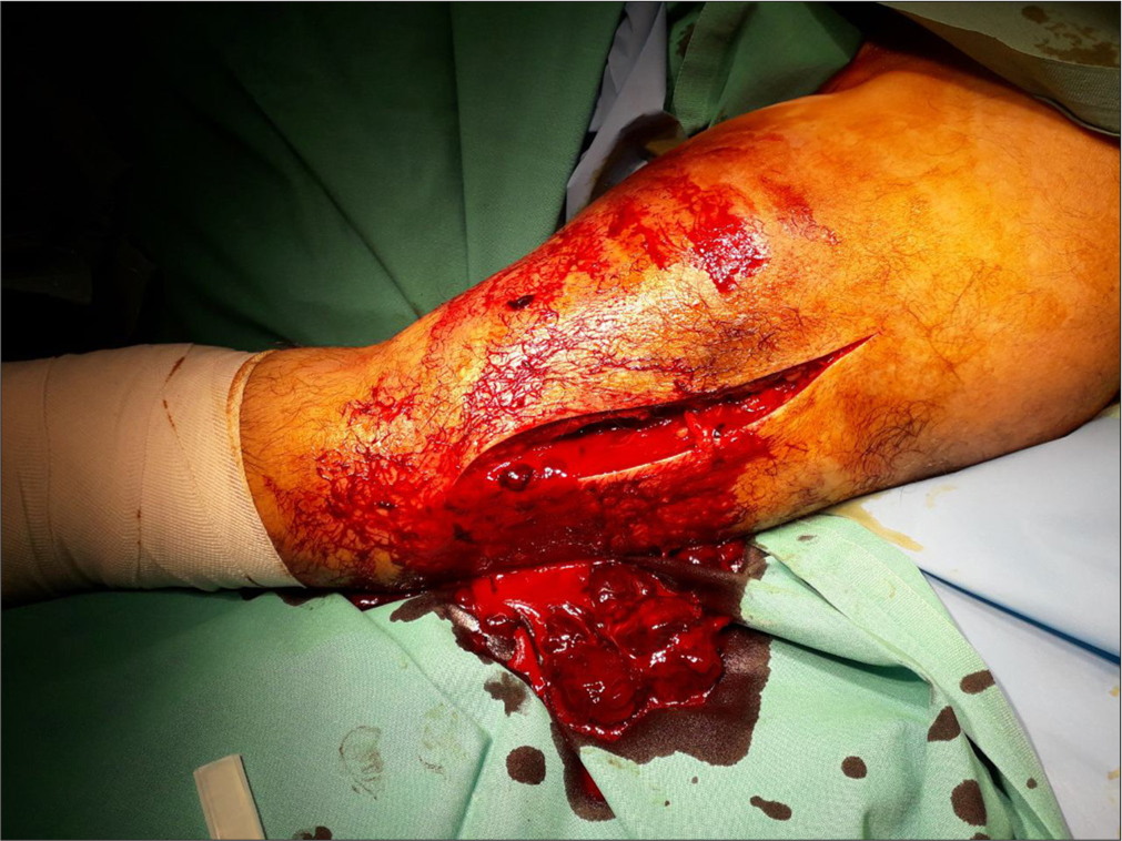 The evacuated hematoma.