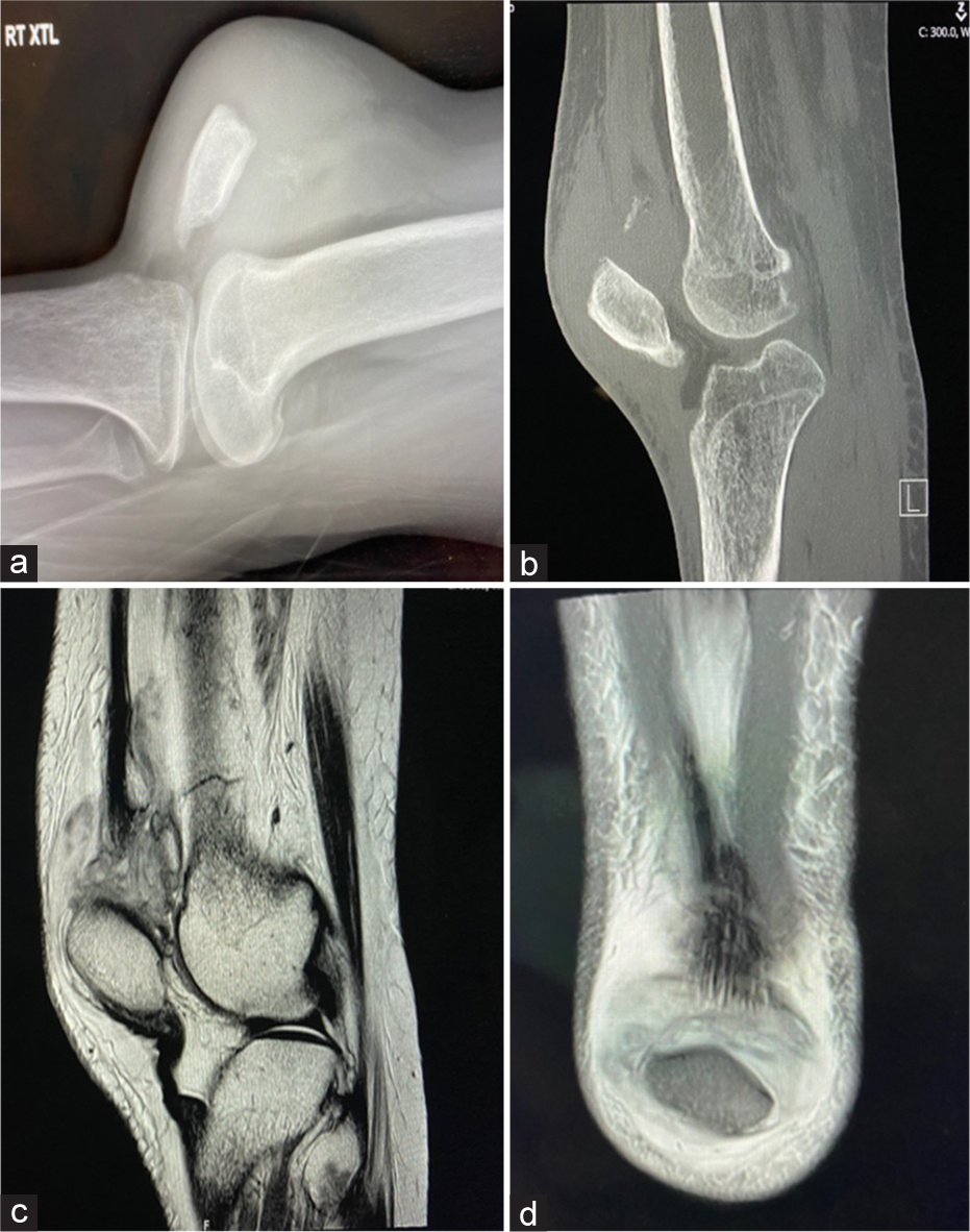 (a) Radiograph of the right knee with obvious effusion and osseous avulsion of the quadriceps tendon, (b) Computed tomography scan, sagittal cut. (c and d) Are magnetic resonance imaging sagittal and coronal cuts clearly identify complete avulsion of the quadriceps tendon.