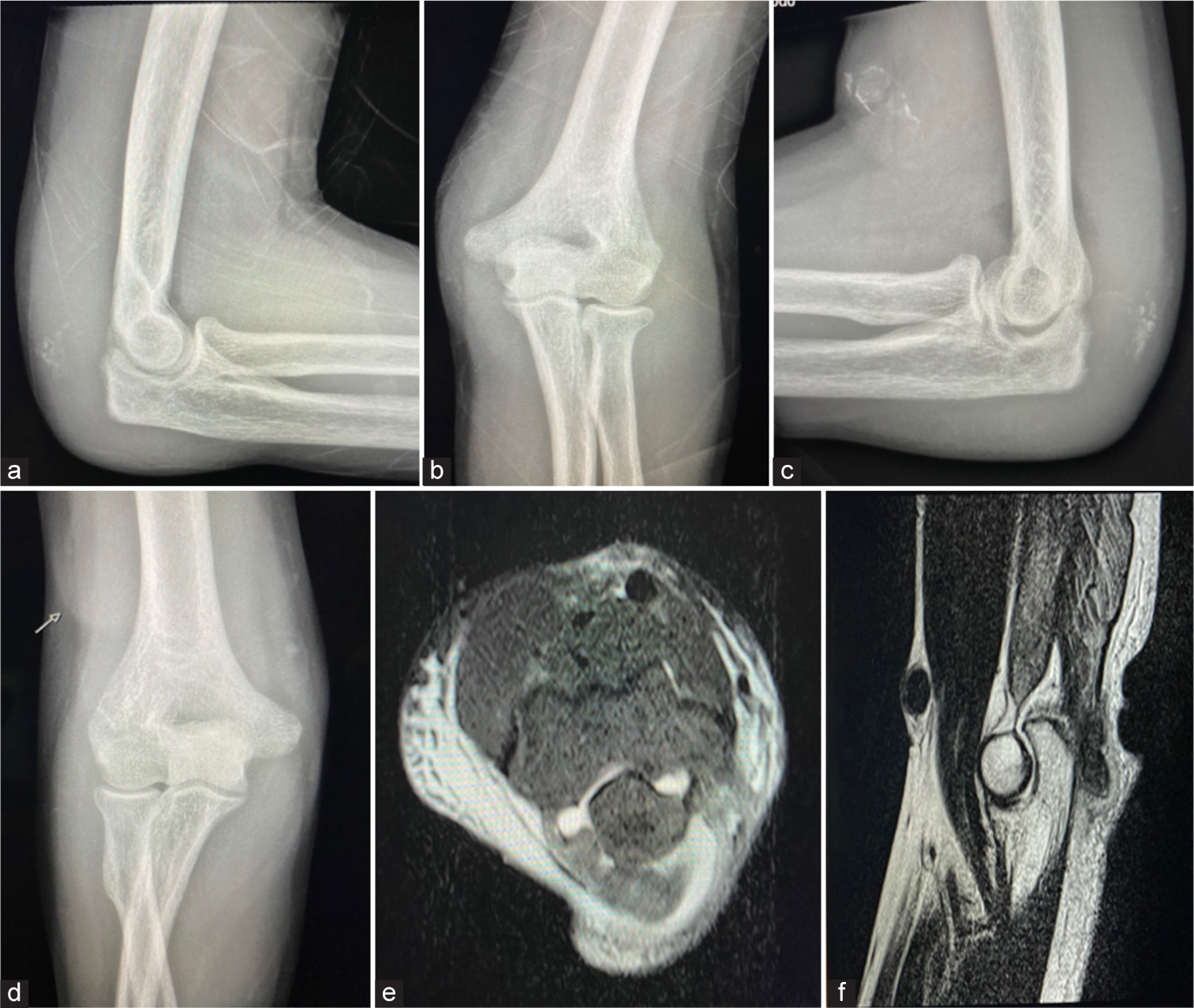 (a and b) Left, (c and d) Right X-rays of elbows show effusion, fat pad sign with soft-tissue swelling and calcification over distal triceps (arrow), more obvious on the right side. (e and f) Are magnetic resonance imaging axial and sagittal cuts with a complete triceps tendon tear.