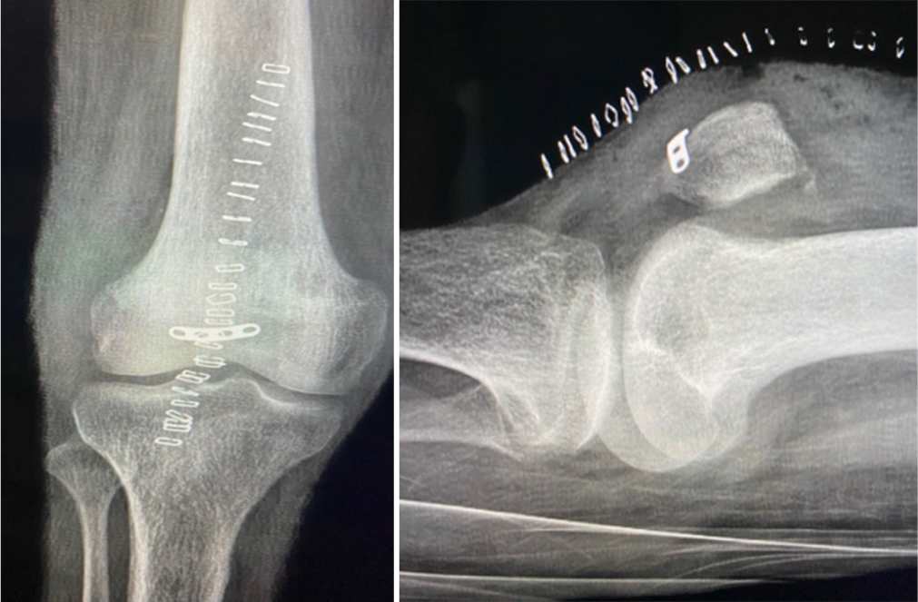 Post-operative radiographs of the right knee.