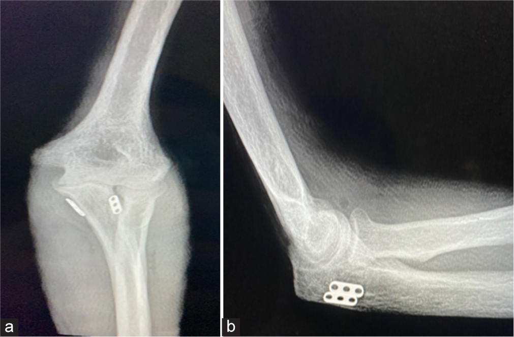 (a and b) Post-operative radiographs of the elbows. b