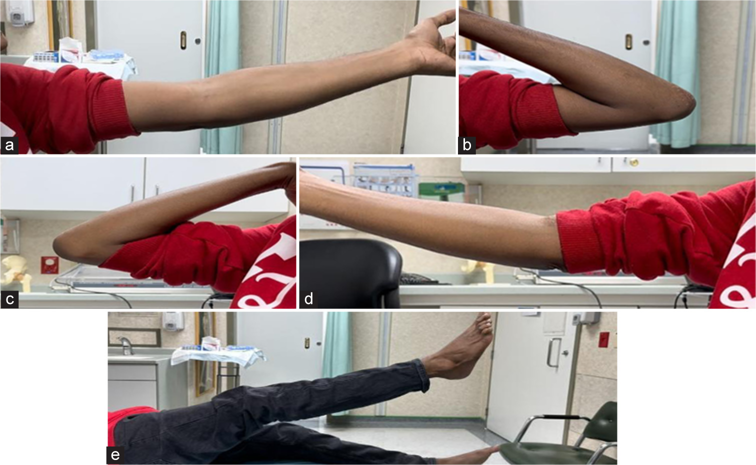 Last visit (16 weeks) clinical photographs show (a-d) range of motion and (e) intact extensor mechanism.