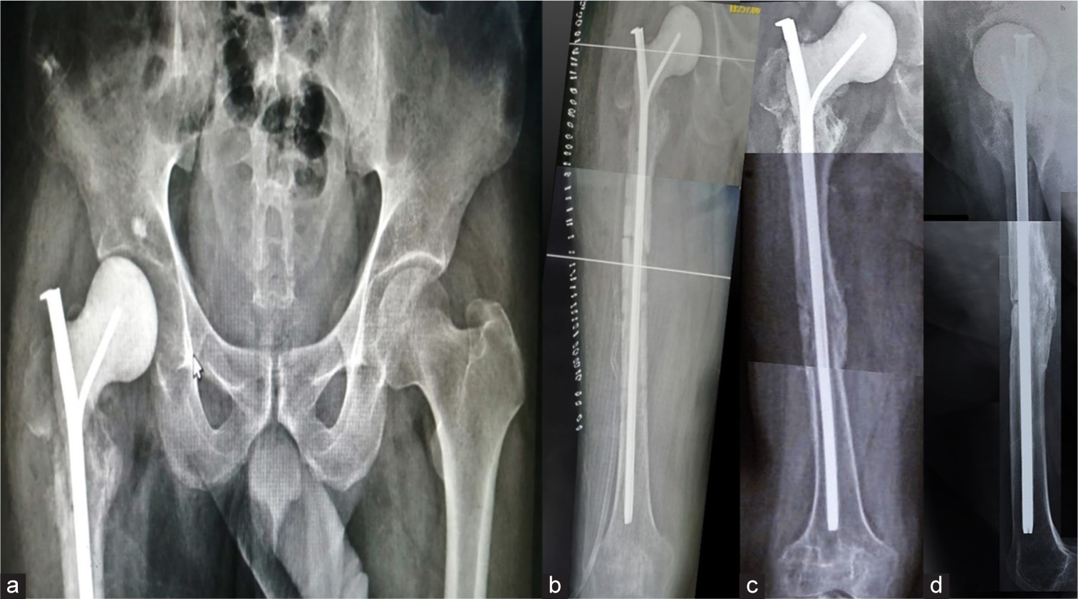 (a and b) Immediate postoperative radiograph shows a handmade spacer with proper offset. (c and d) The last follow-up radiograph shows a consolidated mid-diaphyseal osseous union.