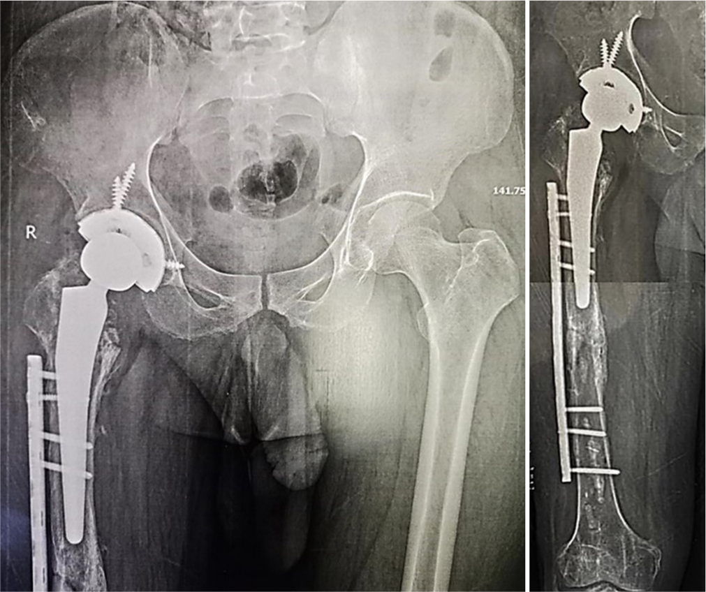 Second-stage cementless total hip replacement with a prophylactic plate for femoral fracture.