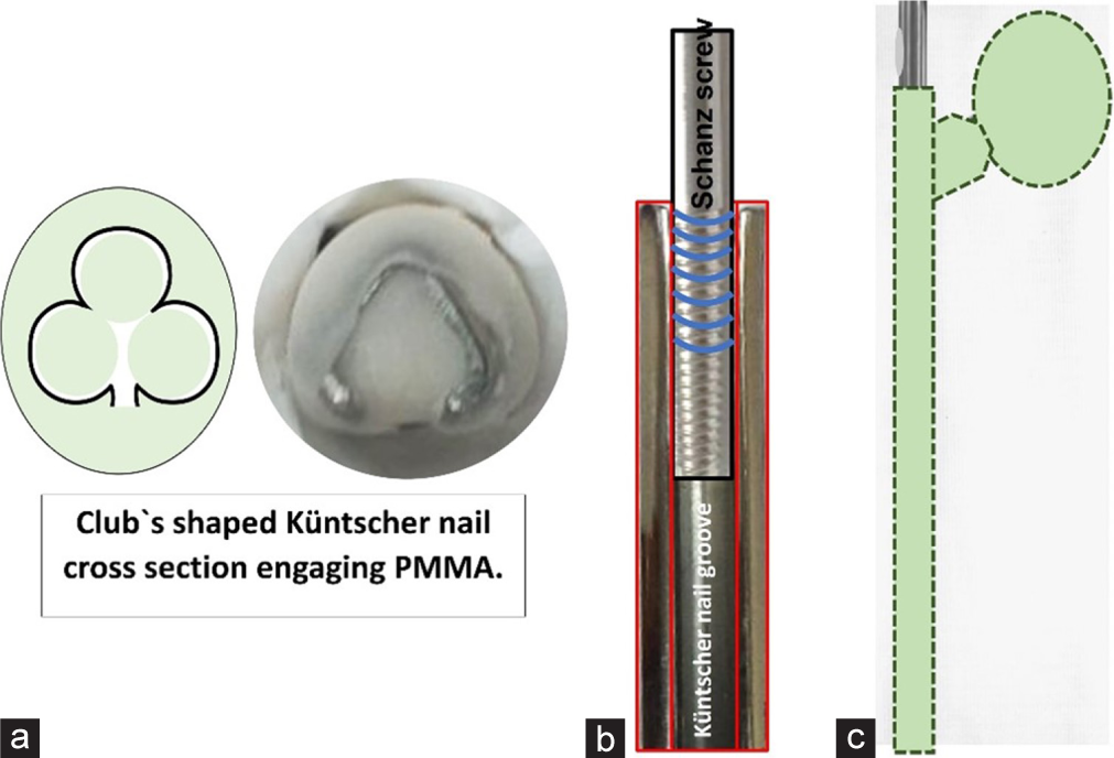 The illustrated diagram shows (a) cement nail bonding, (b) Schanz-nail locking mechanism, and (c) handmade space and nail eye for extraction.