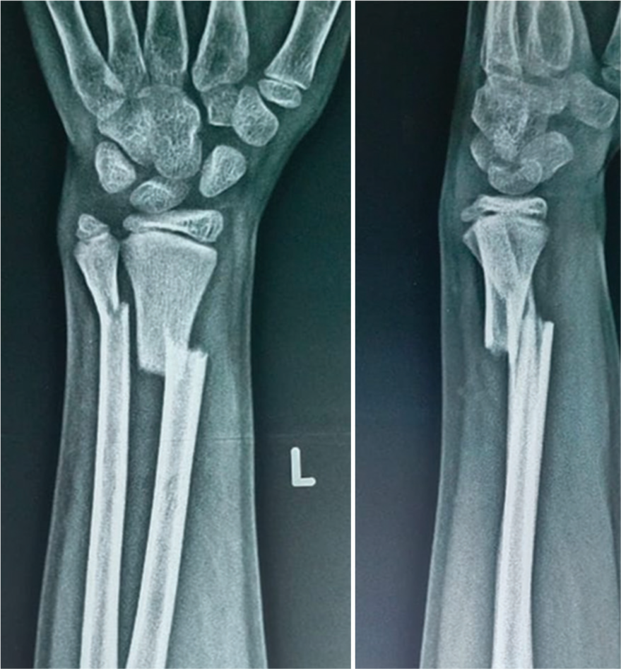 Pre-operative radiographs demonstrating a displaced distal third of the diaphysis fracture in an 11-year-old boy.