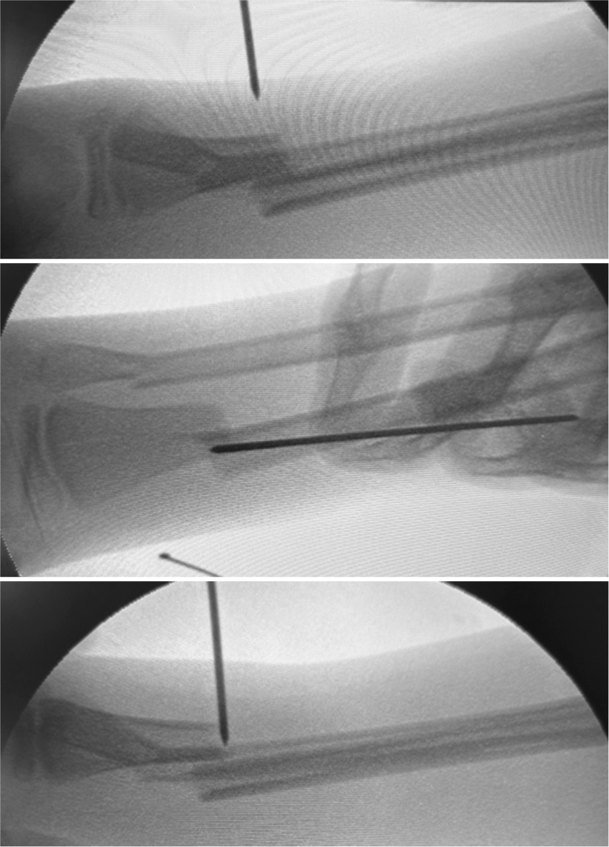 Intraoperative fluoroscopic images showcasing the sequential steps of dorsal percutaneous K-wire insertion.