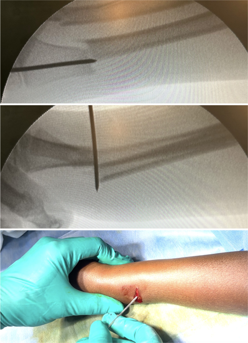 An intraoperative fluoroscopic image illustrating how retrograde intrafocal K-wire insertion can exacerbate deformity and displacement in unstable radius fractures.