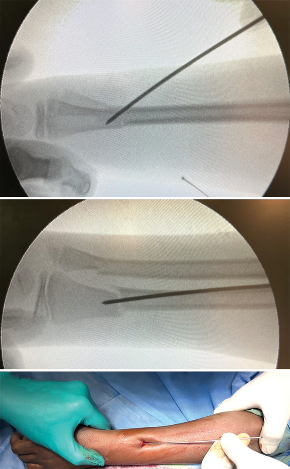 An intraoperative fluoroscopic image demonstrating initial radius fracture reduction using the first antegrade K-wire.