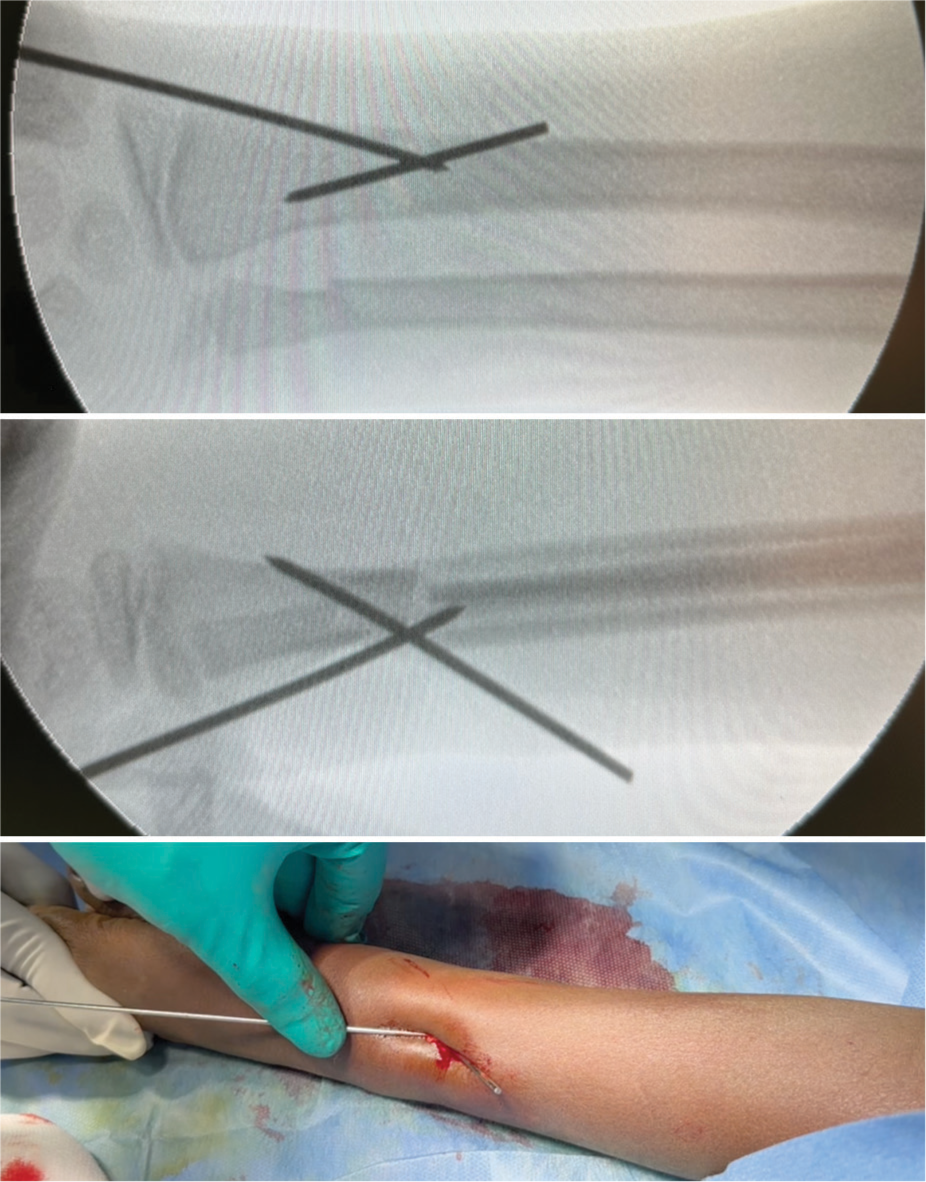 An intraoperative fluoroscopic image showing further reduction and stabilization of the radius fracture achieved with the second retrograde K-wire.