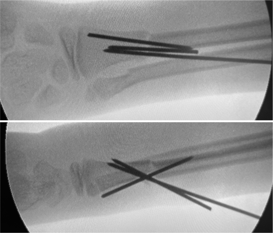 An intraoperative fluoroscopic image highlights the final alignment and stabilization of the radius fracture fragments using the third antegrade K-wire.