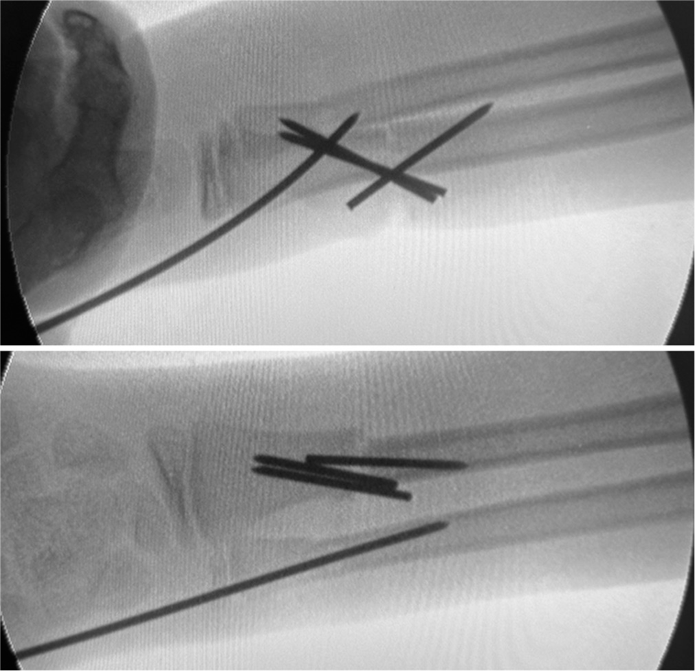 An intraoperative fluoroscopic image depicting reduction of the distal ulna fracture with a retrograde K-wire.