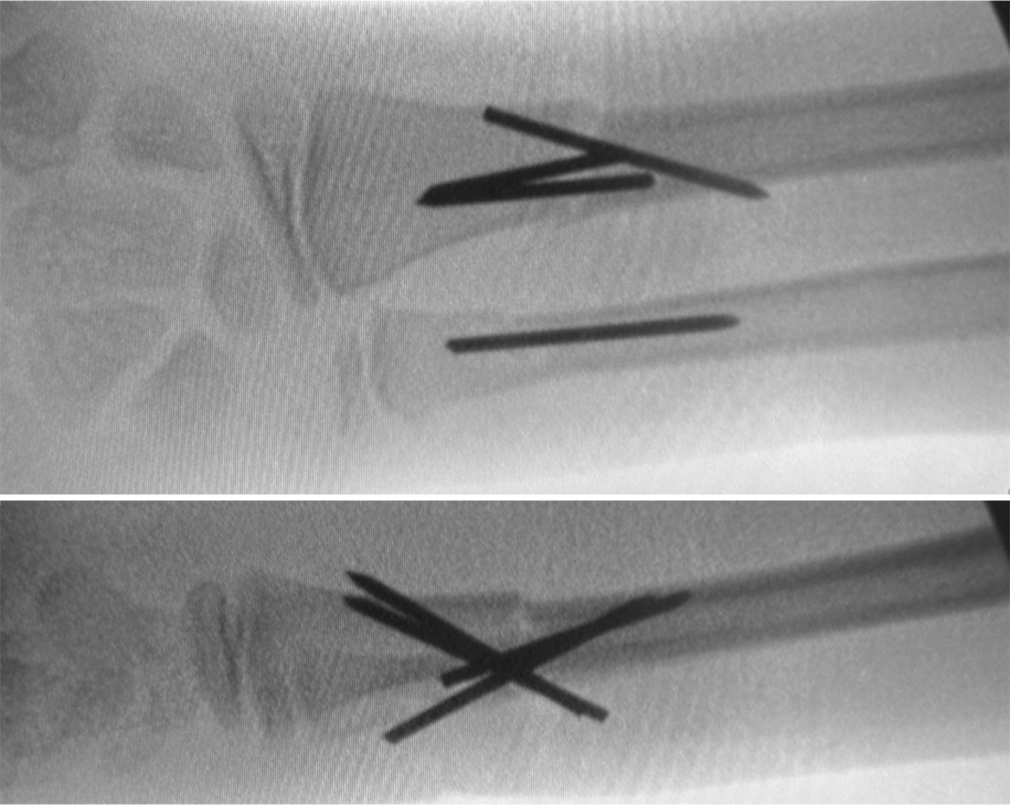 Final intraoperative fluoroscopic image showcasing the successful reduction of both distal third of the diaphysis fractures using the combined antegrade and retrograde intrafocal K-wire pinning technique.