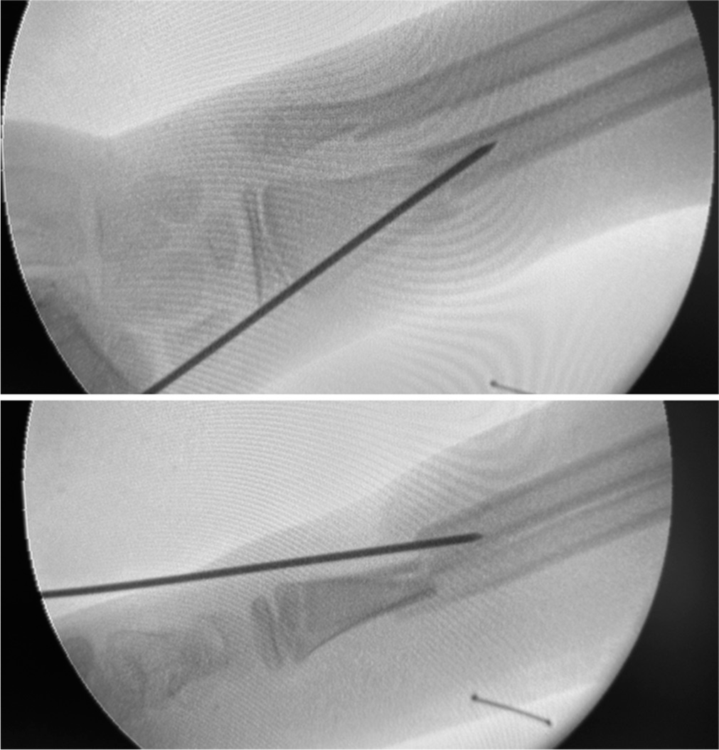 An intraoperative fluoroscopic image illustrating how retrograde K-wire insertion can convert dorsal displacement to volar displacement in unstable, completely displaced fractures due to periosteal and soft-tissue injury.