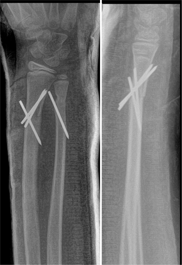 Three-week post-operative radiographs demonstrating acceptable fracture alignment in the illustrative case.