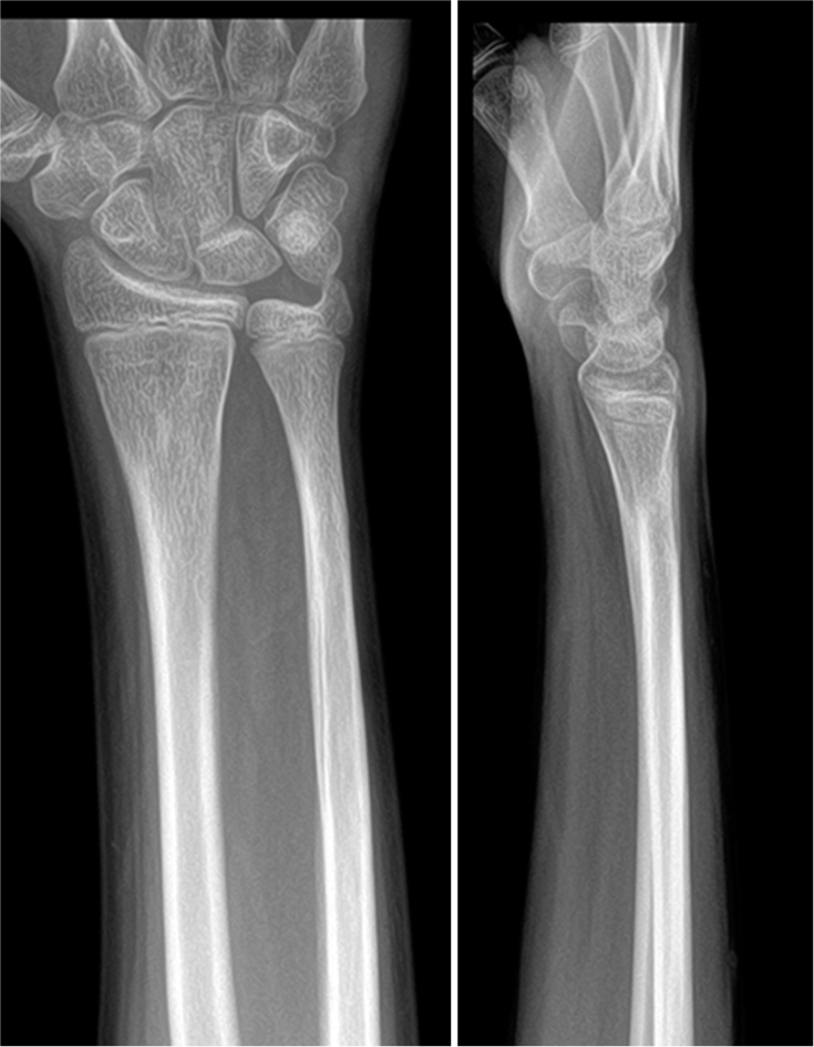 One-year follow-up radiographs showing well-united distal third of the diaphysis fractures.