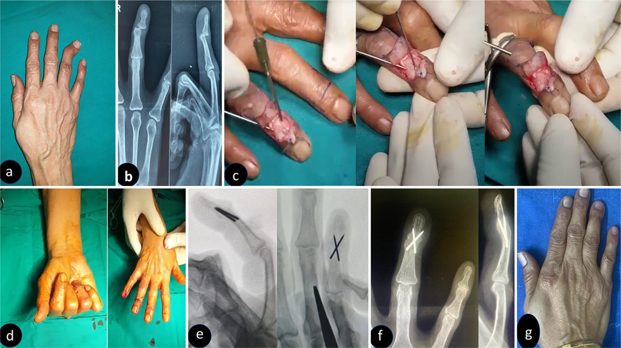 (a) Clinical picture showing untreated dislocation of distal interphalangeal joint of the right ring finger. (b) Anteroposterior and lateral radiographs confirming the distal interphalangeal joint dislocation. (c) Intraoperative pictures showing the cross-crimped wires cut flush to the outer cortex. (d) Intraoperative pictures showing no deformity (case done under wide awake hand surgery). (e) C-Arm pictures with a satisfactory position of K-wires. (f) Two-year follow-up radiographs showing good fusion of distal interphalangeal joint and no migration of the K-wires. (g) Clinical picture showing no deformity.