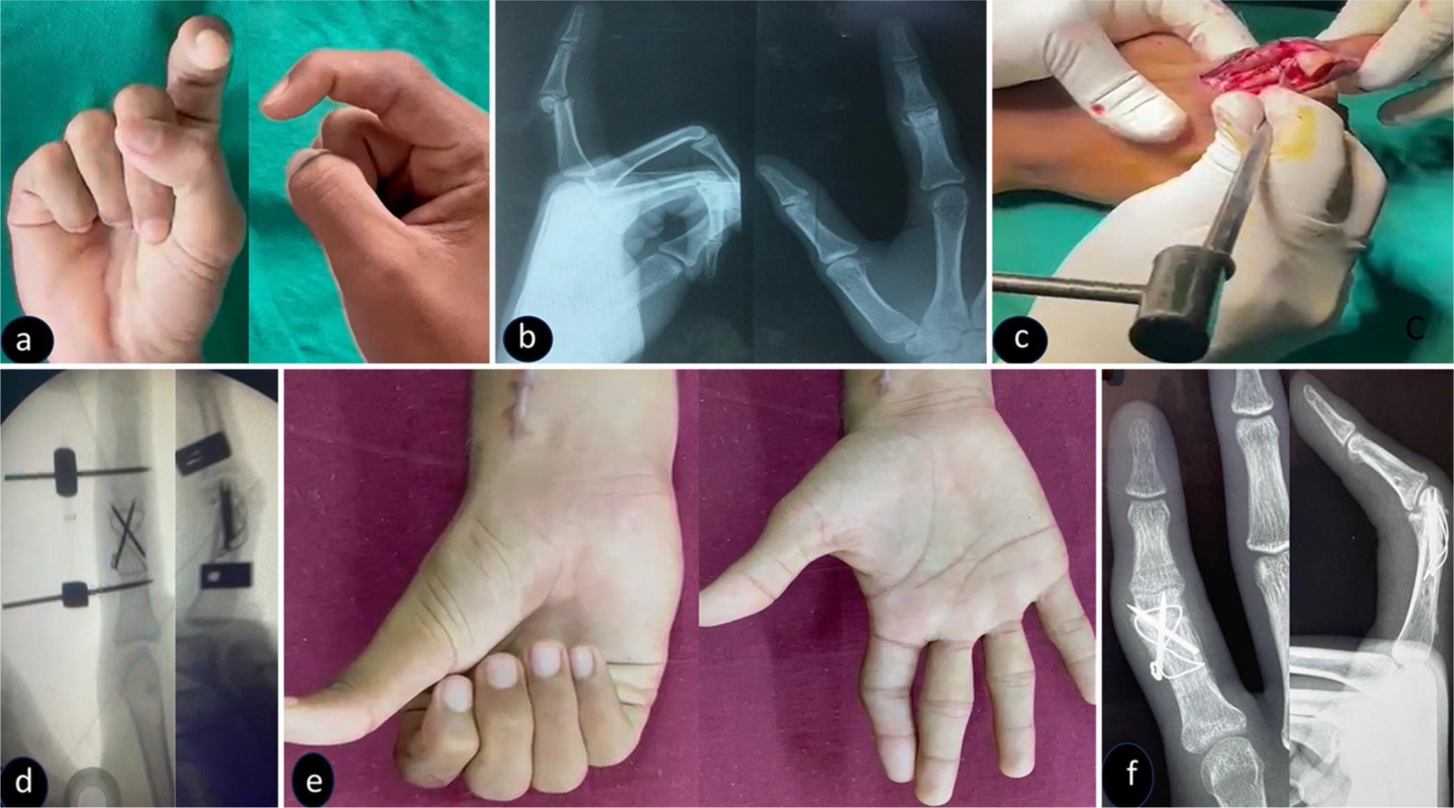 (a) Clinical picture showing deformity of proximal interphalangeal joint and a good range of movement at distal interphalangeal joint. (b) Radiograph showing malunited fracture of neck of proximal phalanx of the index finger. (c) Intraoperative picture showing osteotomy of the fracture site. (d) Intraoperative C-arm picture showing cross crimped K-wire with a figure of “8” stainless steel wire (28-gauge) to fix the osteotomy. (e) One-year follow-up picture showing a decent range of movement at the proximal interphalangeal joint. (f) One-year follow-up radiographs showing good union of fracture site with no migration of K-wires into the joint.