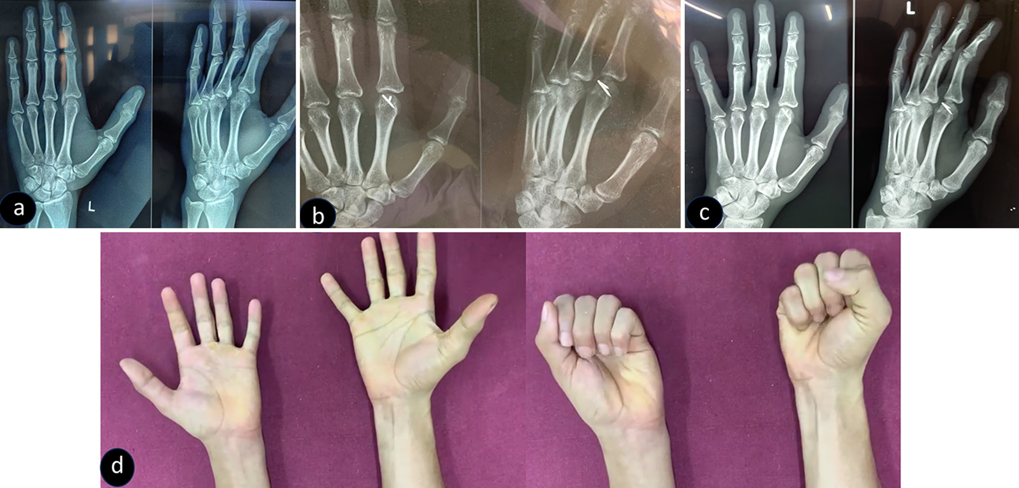 (a) Radiograph showing second metacarpal head fracture with a sliver of bone (associated with extensor tendon and capsule injury). (b) Immediate post-operative radiograph showing fracture of 2nd metacarpal head fixed with crimped wires. (c) One-year follow-up radiograph showing healed fracture with no wire penetration into the joint. (d) One-year follow-up clinical picture showing a good range of movement at the metacarpophalangeal joint.