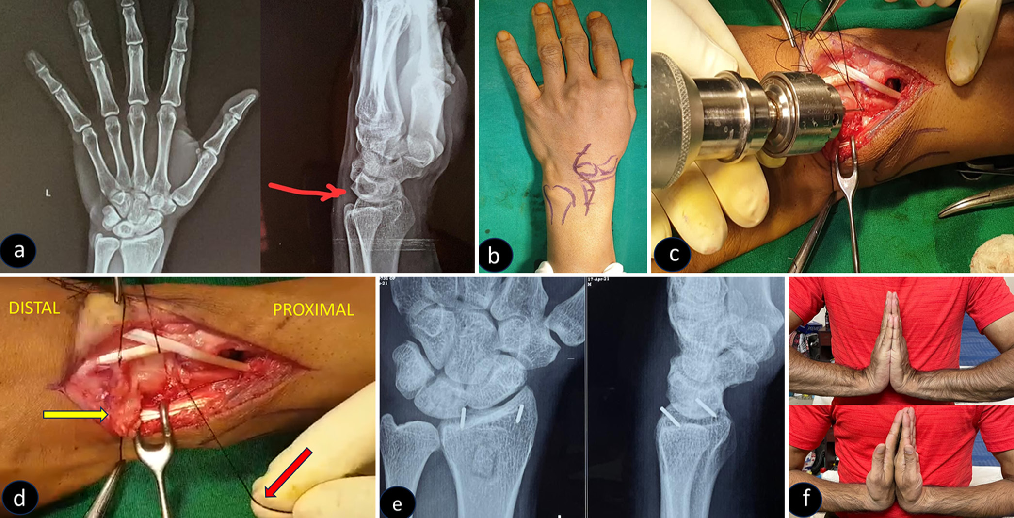 (a) Radiograph showing lytic lesion of lunate bone in anteroposterior and lateral views (red arrow). (b) Clinical picture showing the planned surgical incision. (c) Intraoperative picture showing the introduction of our suture anchor. (d) Intraoperative picture showing distal-based dorsal capsular reflection (Yellow pointer). Picture of an anchor being pulled by the surgeon (Red pointer). (e) Two-year follow-up radiograph showing healed lytic lesion of the lunate and healed bone graft donor site. (f) Two-year follow-up clinical picture showing a good range of movement at the wrist joint.