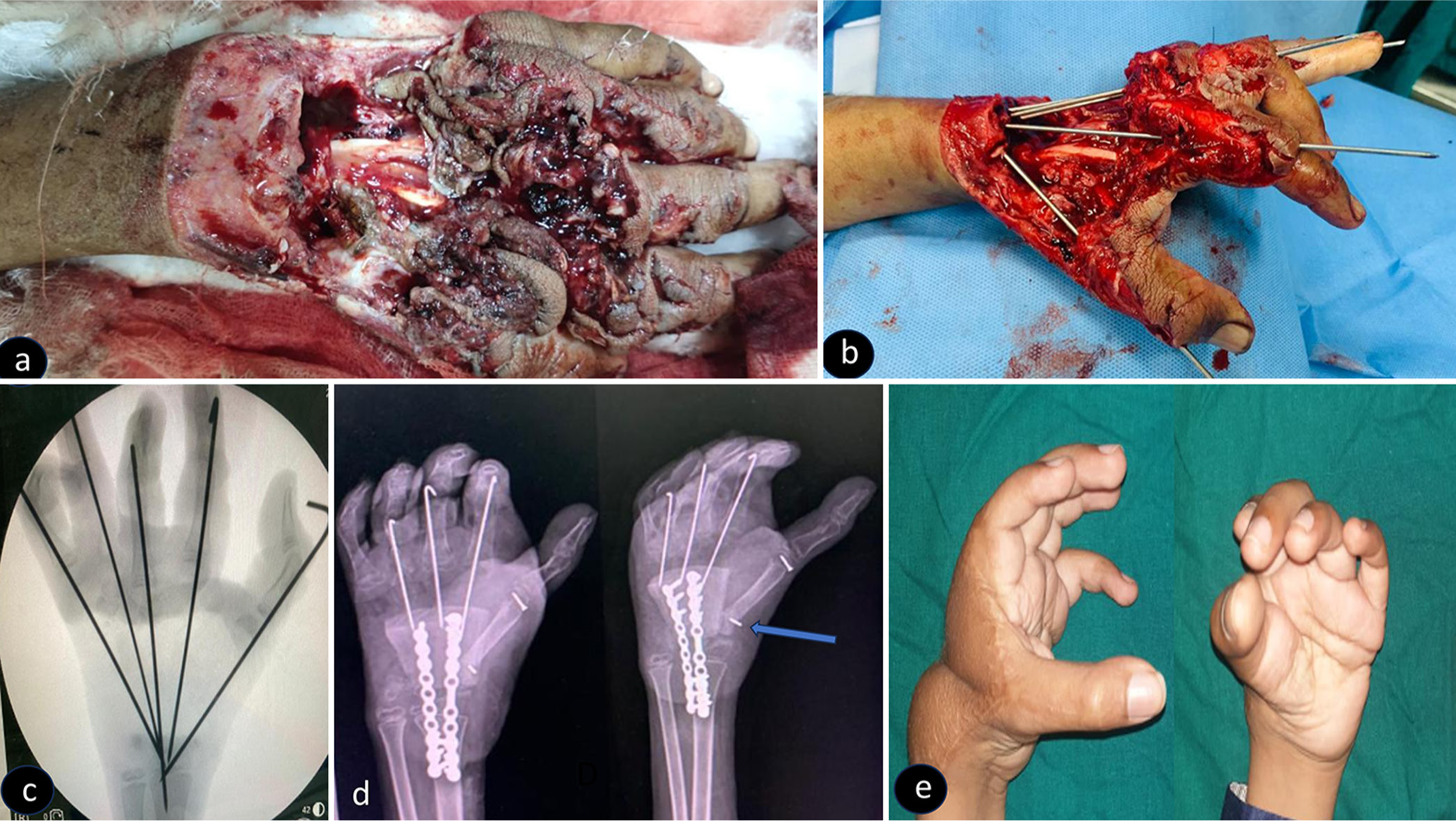 (a) Clinical picture of a young boy with a crush injury resulting in dorsal composite tissue loss over the left hand. (b) Intraoperative picture showing debridement and K-wire fixation to maintain the length of the metacarpal bone. (c) Radiograph showing reconstruction following groin flap, tricortical iliac crest graft, and reversed 4th metatarsal for the reconstruction of first metacarpal. (d) The abductor pollicis longus tendon was secured to the base of the newly constructed first metacarpal with our suture anchor (Blue pointer). (e) Clinical picture showing the follow-up at 1-1/2 years.