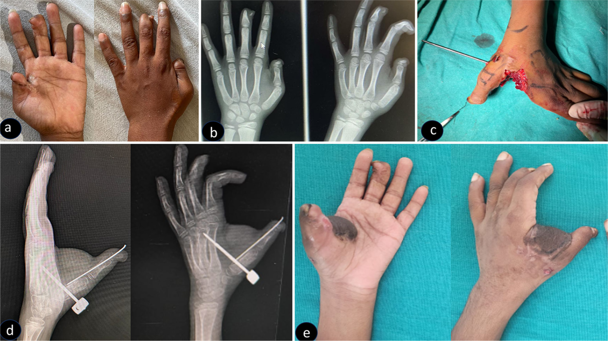 (a) Clinical picture showing left first webspace post burns contracture. (b) Radiographs showing decreased intermetacarpal angle between 1st and 2nd metacarpals. (c) The contracture was released and maintained with our modified K-wire with two threaded portions, and groin flap coverage was done. (d) Radiograph showing maintained intermetacarpal angle between first and second metacarpals. (e) Clinical picture at a six-month follow-up with maintained 1st webspace.