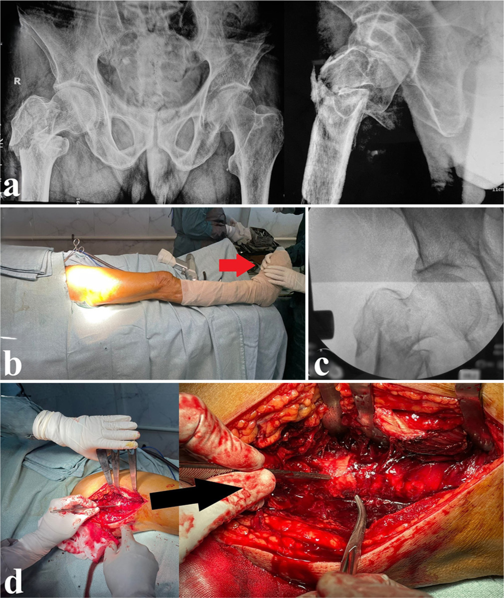 Demonstration case of a male patient, 80 years old, presented with unstable intertrochanteric fracture (classified as AO/31A2). (a) Preoperative anteroposterior (AP) and lateral views showing the fracture configuration. (b) After draping, the assistant holds the lower limb with gentle traction after performing a trial of fracture reduction (red arrowhead). (c) A fluoroscopic AP view showing the irreducibility of the fracture. (d) Surgical approach and finding the key fragment to achieve proper fracture reduction (black arrowhead).