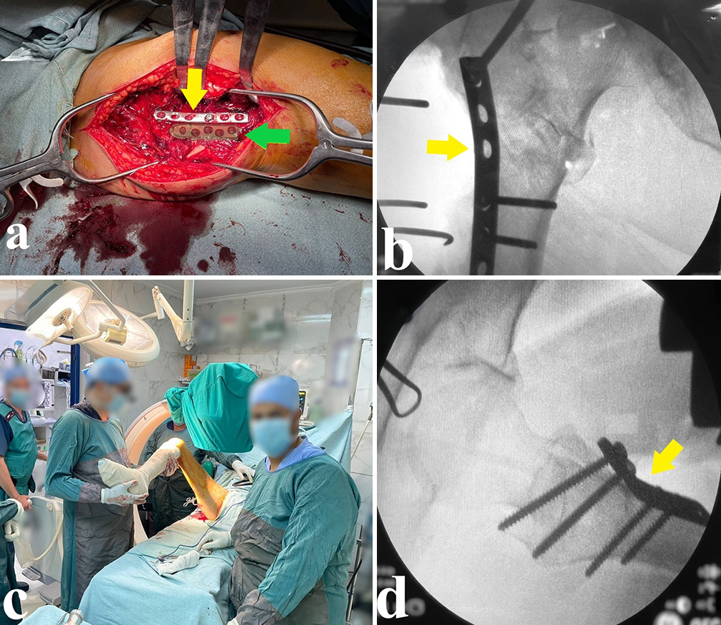 (a) After initial near anatomical fracture reduction, preliminary fixation using an anterolateral narrow DCP (yellow arrowhead) was performed (the plate position is selected not to interfere with the position of the dynamic hip screw side plate, shown as a green overlay and indicated by the green arrowhead). (b) Checking the fracture reduction, anterolateral plate position (yellow arrowhead), and fracture initial fixation in the anteroposterior view. (c) Obtaining a lateral view by hip flexion, abduction, and external rotation. (d) Checking the fracture reduction and anterolateral plate position in the lateral view (yellow arrowhead). DCP: Dynamic compression plate.